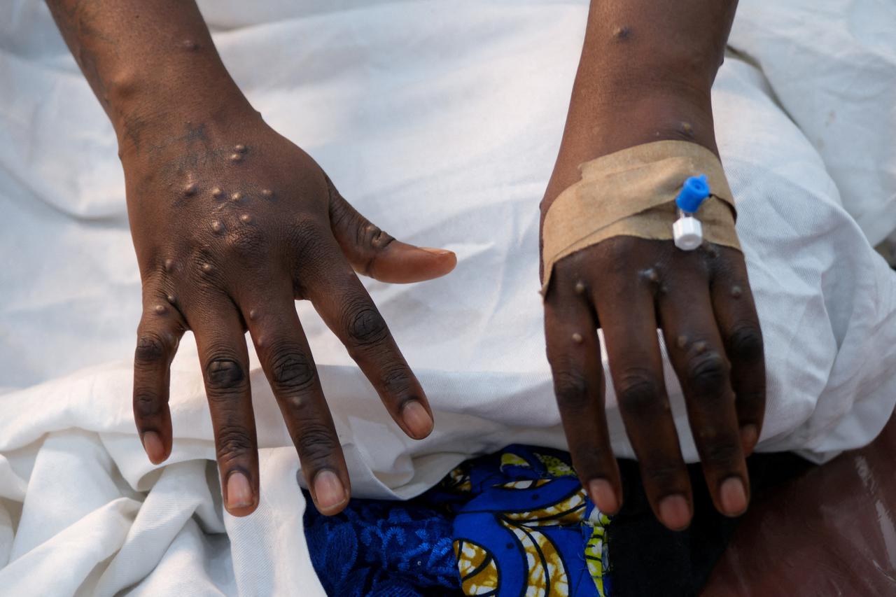 FILE PHOTO: The hands of a patient with skin rashes caused by the mpox virus are pictured in Kinshasa