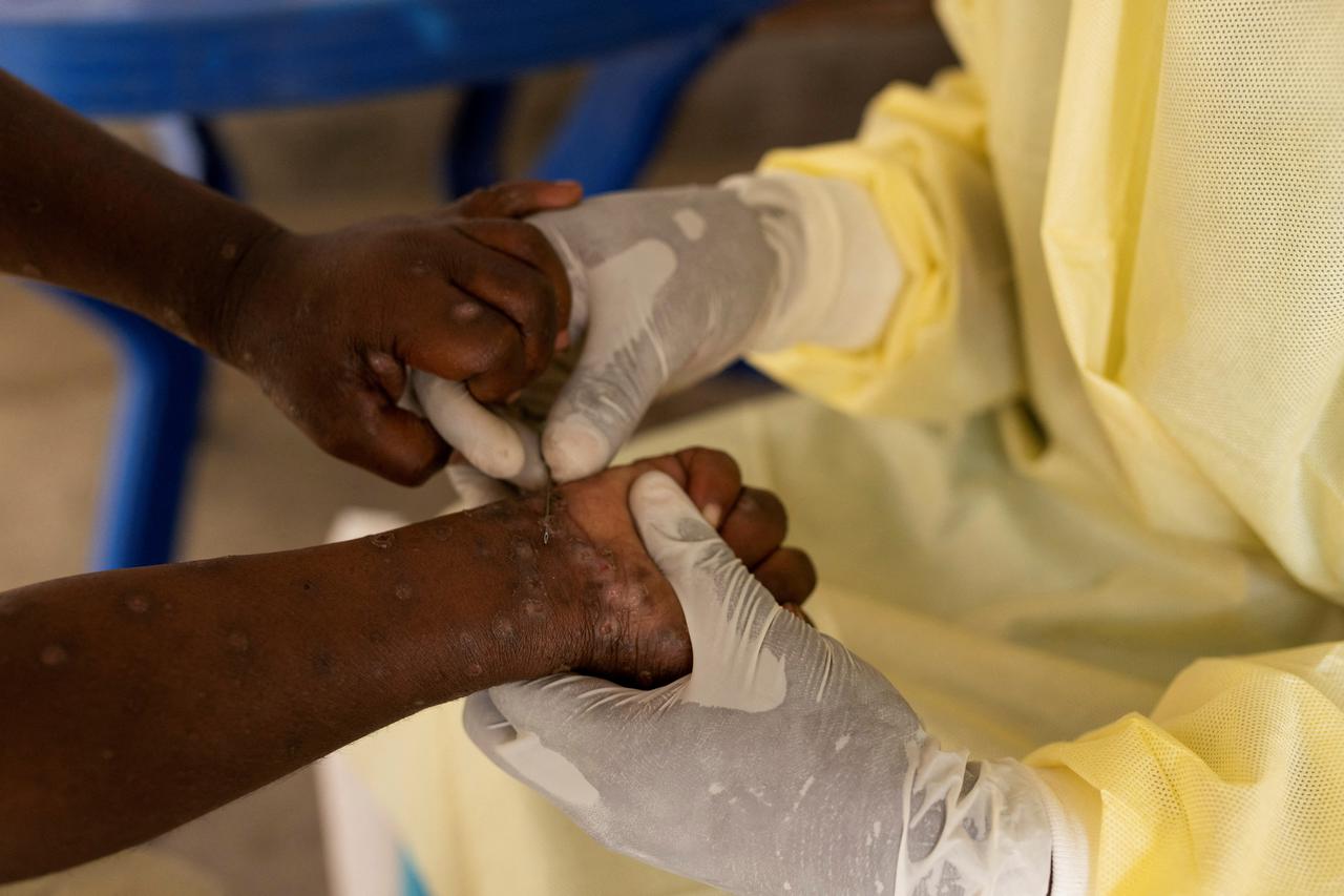 FILE PHOTO: Christian Musema, a laboratory nurse, takes a sample from a child declared a suspected case of Mpox