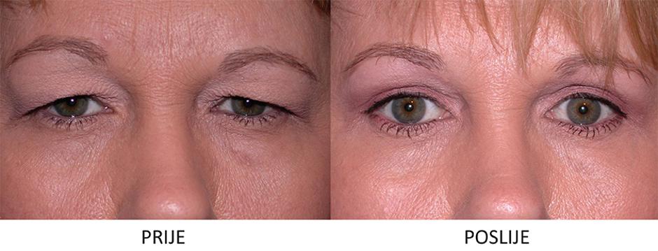 blefaroplastika