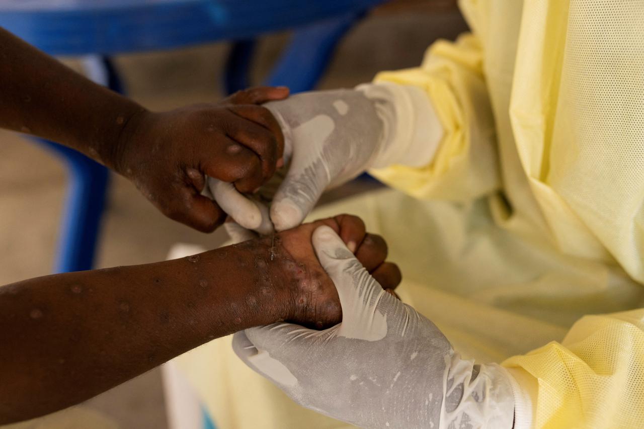 FILE PHOTO: Christian Musema, a laboratory nurse, takes a sample from a child declared a suspected case of Mpox