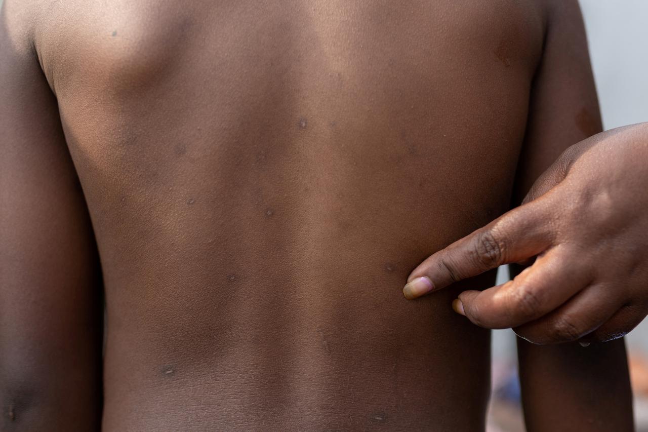 FILE PHOTO: Rash marks on child in  Congo, who recovered from mpox