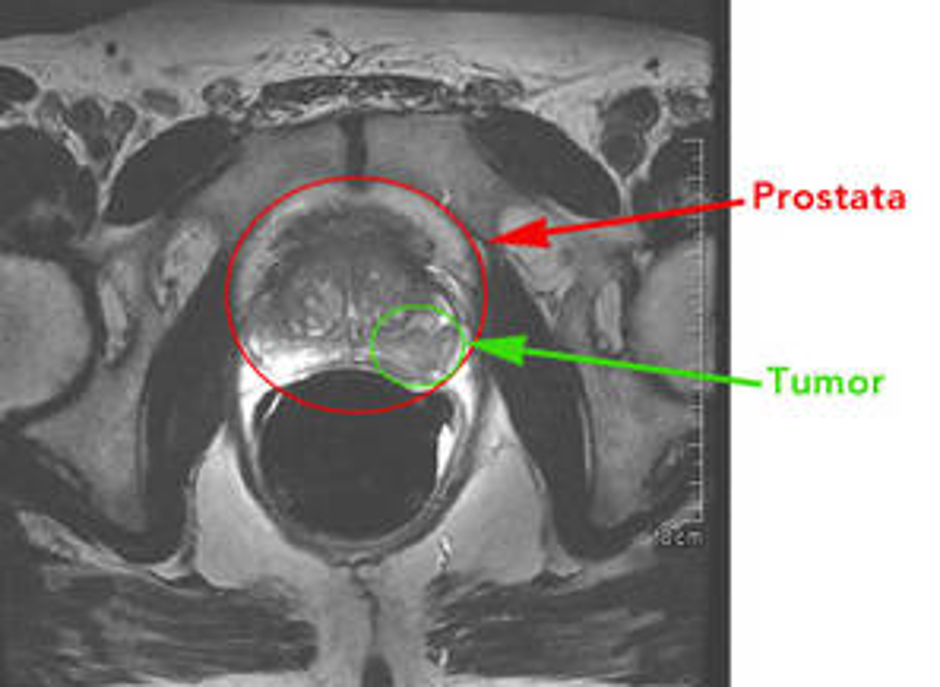 Prostata