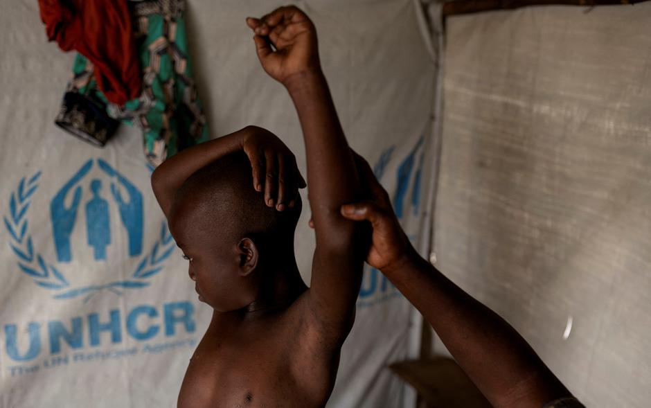 Children at risk as mpox variant hits Congo displacement camps